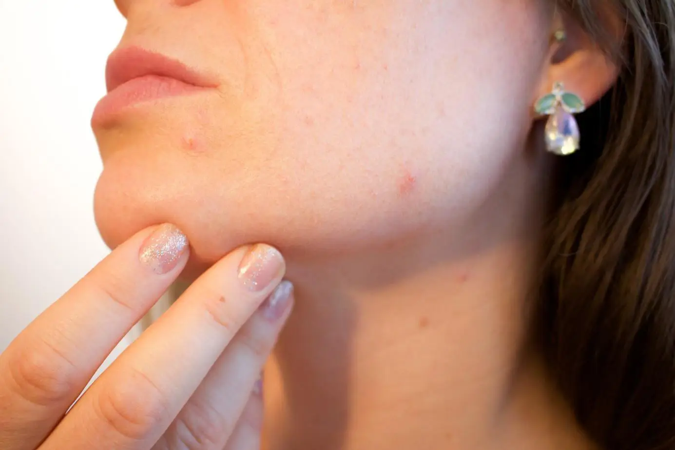 comment soigner l'acné