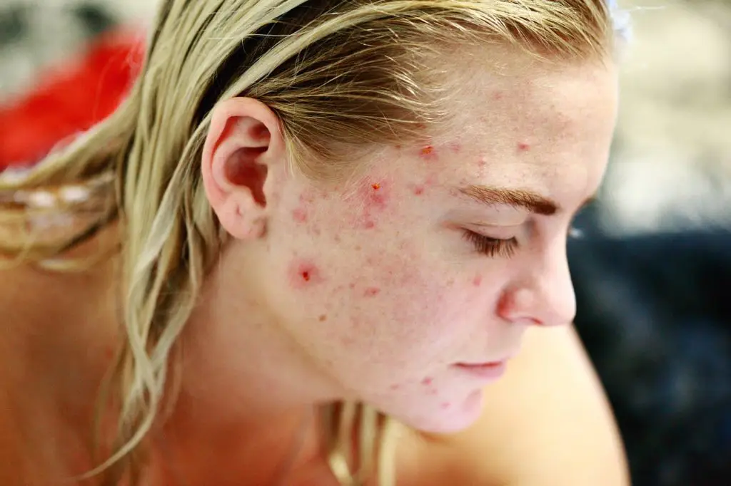 Une adolescente atteinte de poussée d'acné violente
